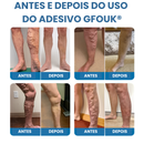 Adesivo Antivarizes Gfouk®