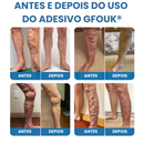Adesivo Antivarizes Gfouk®